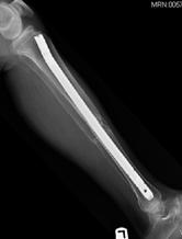 Nail Percutaneous BMA Open Injury,