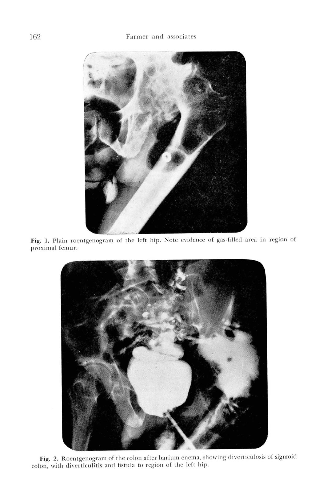 174 Farmer and associates Fig. 1. Plain roentgenogram of the left hip. Note evidence of gas-filled area in region of proximal femur. Fig. 2.