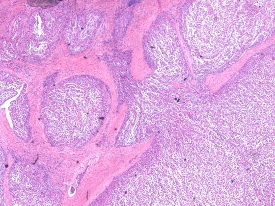 Widely invasive carcinoma 61 Dissecting Indeterminates Thyroid nodule management Indeterminates : Benign vs.