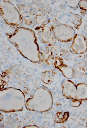 CK19 HBME 19 New Challenge Is this follicular variant or is this noninvasive follicular tumor with