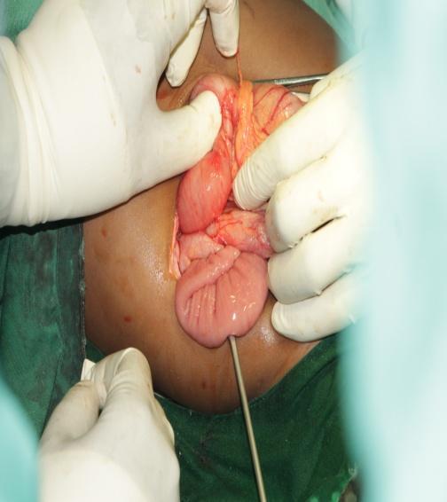 laparoscopic gastro-jejunostomy".