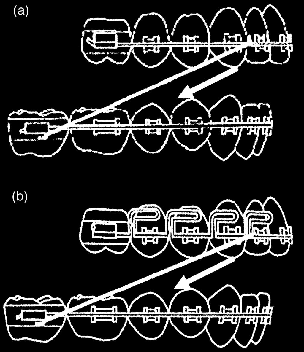 MOVEMENT OF THE MAXILLARY TEETH BY THE MEAW 341 canine.