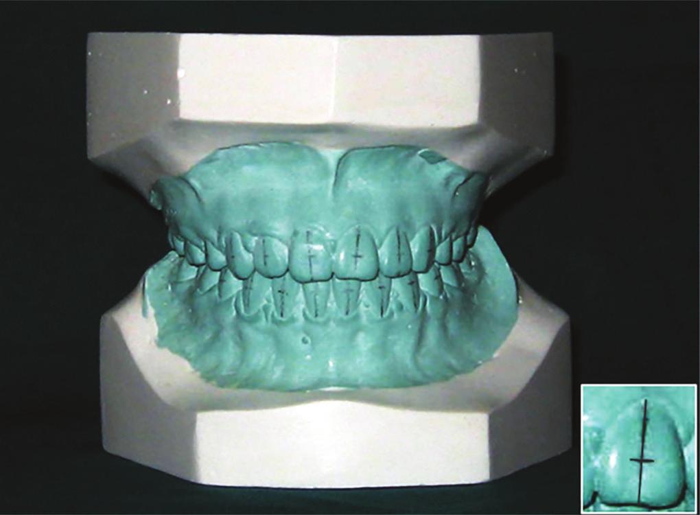 2,4-6 Recently, Sondhi 7 attempted to evaluate the effectiveness of appliance design on a virtual dentition and allow for an objective comparison of the effects of different torque and angulation.