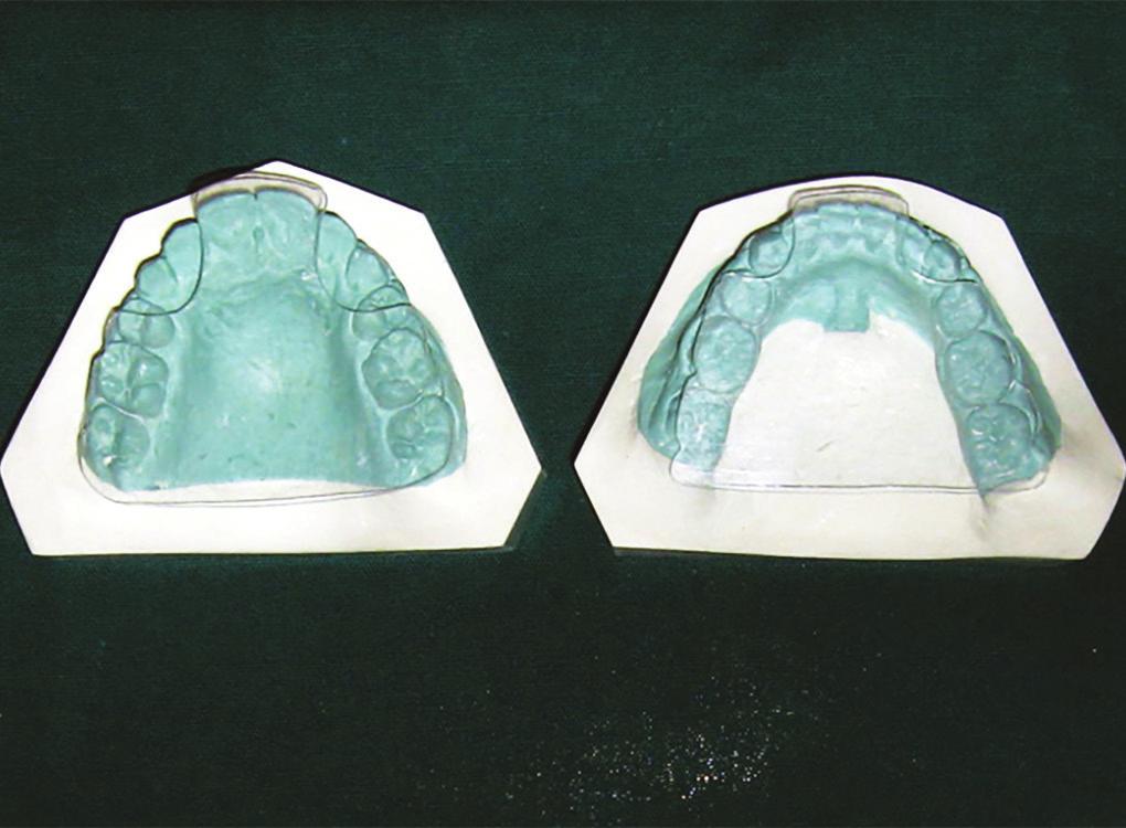 Rishabh Gupta et al Fig. 3: Plastic occlusal templates set on the teeth Fig.