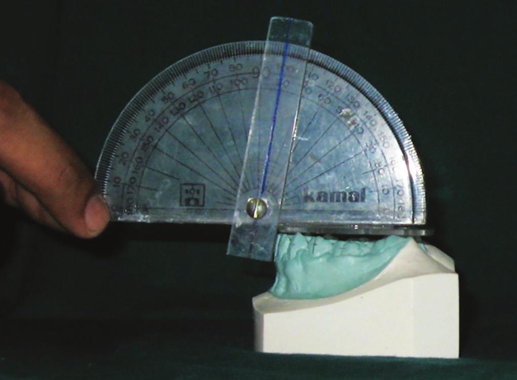 The protractor was placed upright on the plastic template parallel to a line joining the contact points of the tooth being measured.