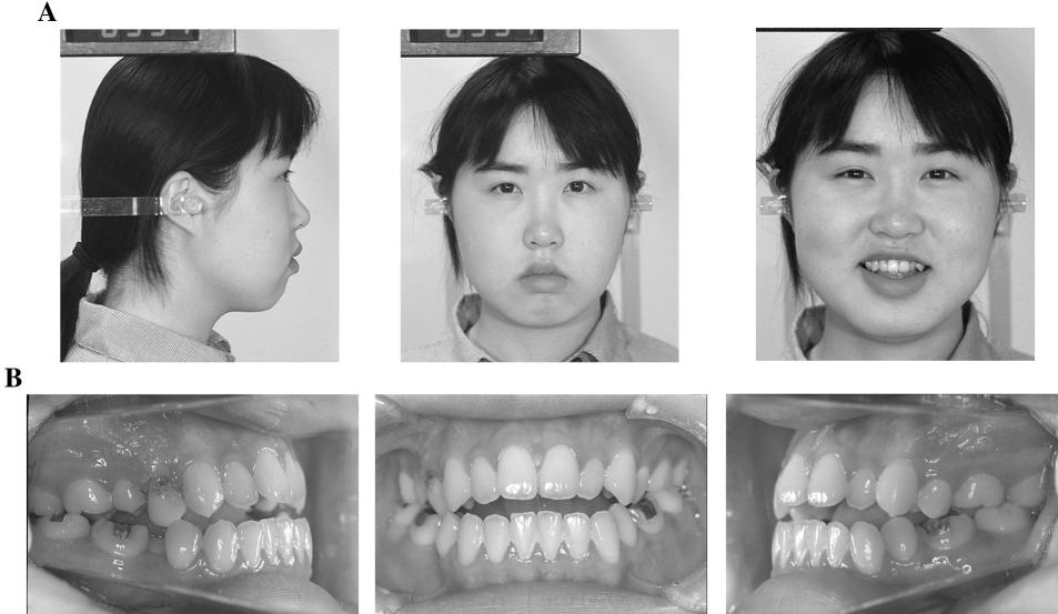 278 SAITO, YAMAKI, HANADA FIGURE 1. Pretreatment (A) facial and (B) intraoral photographs at 19 year one month of age.