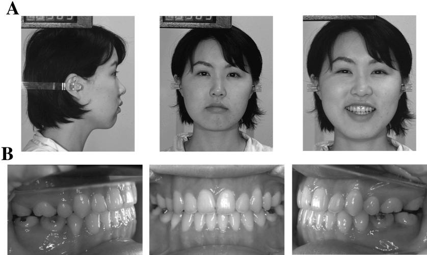 280 SAITO, YAMAKI, HANADA FIGURE 5. Posttreatment (A) facial and (B) intraoral photographs taken at 23 months after the onset of active treatment (at 21 year two month old). FIGURE 6.