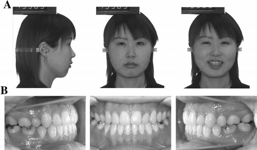 NONSURGICAL TREATMENT OF ADULT OPEN BITE 281 FIGURE 7. (A) Facial and (B) intraoral photographs after retention (at 23 year two month old). FIGURE 8. Panoramic radiograph after retention.