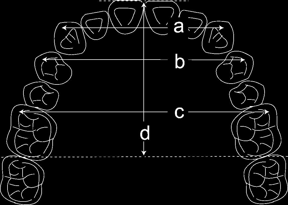 MOLAR DISTALIZATION USING MINISCREW ANCHORAGE 81 Figure 3. Cast analysis. (a) Intercanine width (ICW). (b) Interpremolar width (IPW). (c) Intermolar width (IMW). (d) Coronal arch length.