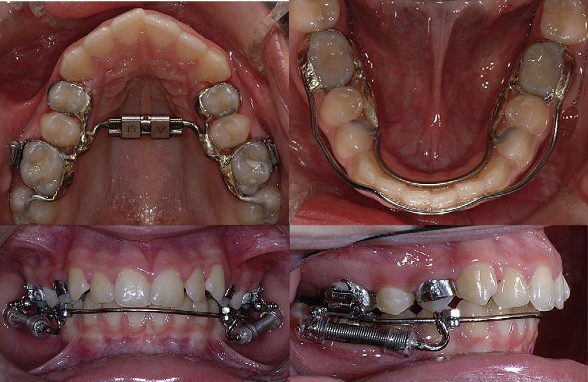 824 Flores-Mir et al American Journal of Orthodontics and Dentofacial Orthopedics December 2009 Fig 1. Xbow appliance: various views. Fig 2.