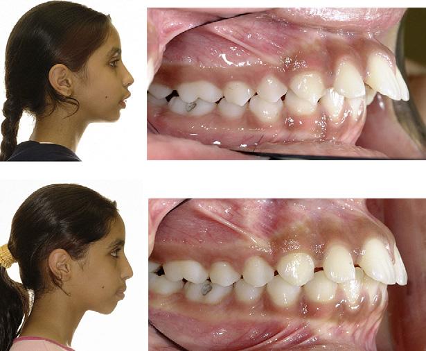 American Journal of Orthodontics and Dentofacial Orthopedics Flores-Mir et al 827 Volume 136, Number 6 Fig 3. Composite tracings at T1, aligned on OL.