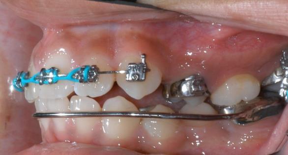 identified. Lower incisors proclined more the longer the treatment.