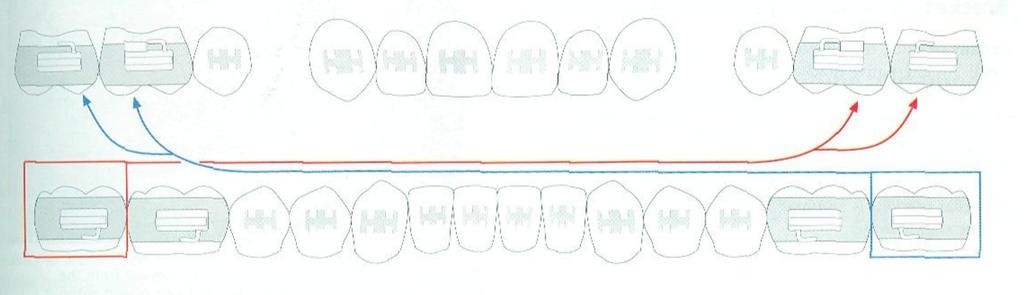 and zero rotation, resulting in mesio-palatal rotation of upper molars, as shown in figure 10 (McLaughlin et al., 2002). Figure 10: case finishing molars, from (McLaughlin et al.