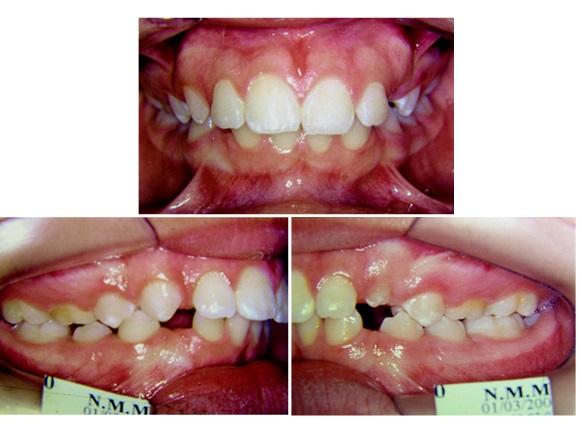 The cases showed orthodontic treatments of transposition between lateral incisor and canine treated by two-plan loop.