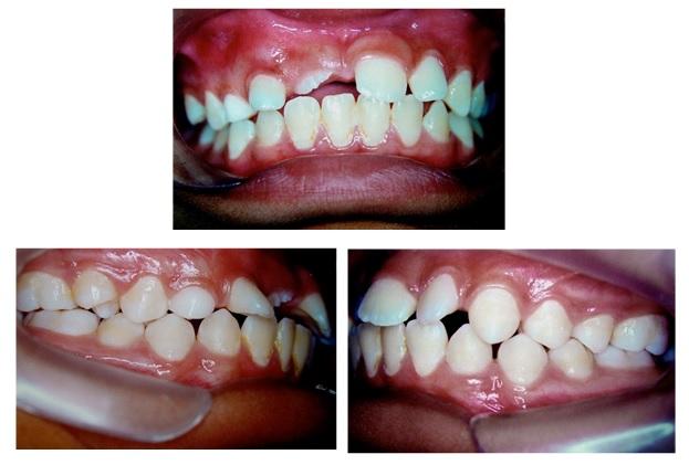 with corrected occlusal guides, without overjet though of the extraction of the bad