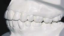 that potential candidates would include those with proclined or procumbent upper or lower incisors,