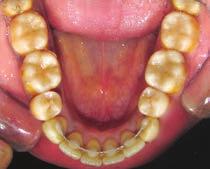 Retainers with occlusal coverage may be helpful in prevertical height of the anterior