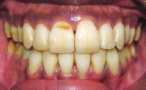 27 Because our patient could afford some extrusion of the upper incisors, we were able to