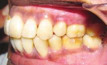 Stability is a concern with any open-bite malocclusion.