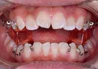 Management of severe Class II malocclusion with sequential removable