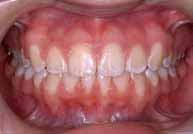 Management of severe Class II malocclusion with
