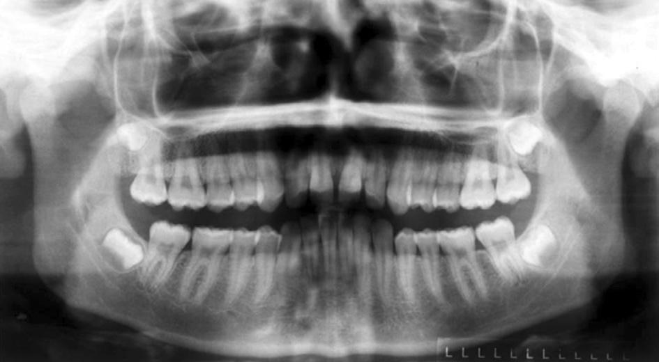 division 1 malocclusion in a female patient outside the maximum pubertal growth peak who was treated by orthodontic camouflage using the MPA and MEAW technique.