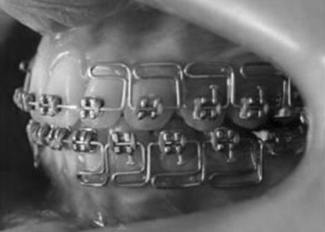 inserted into the maxillary telescopic tube to prevent subsequent