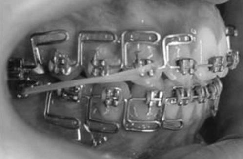 maxillary first molar tube during its placement and to prevent