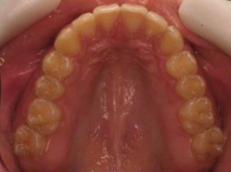 The patient rejected the first option, so nonsurgical treatment comprising mandibular advancement with the MPA and