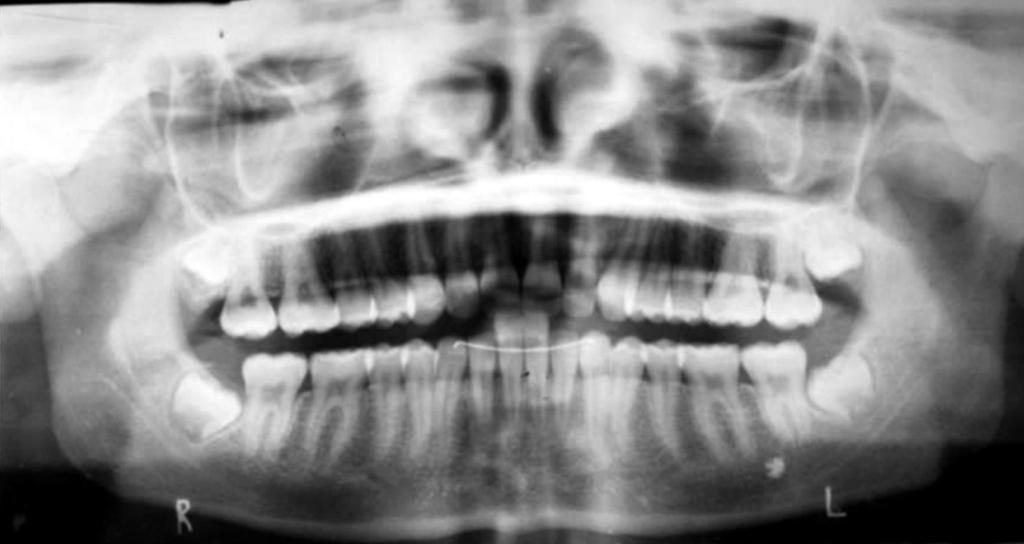 removed after an additional 6 months of use. Although correction of the molar relationship was observed, a mild Class II malocclusion remained in the canine and premolar regions. MEAWs (0.019 0.