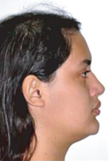 Figure 7. Three-years follow-up facial and intraoral photographs.