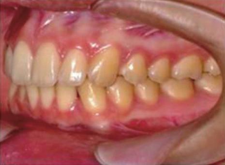 to a level considered to require little or no orthodontic treatment after treatment without extraction.