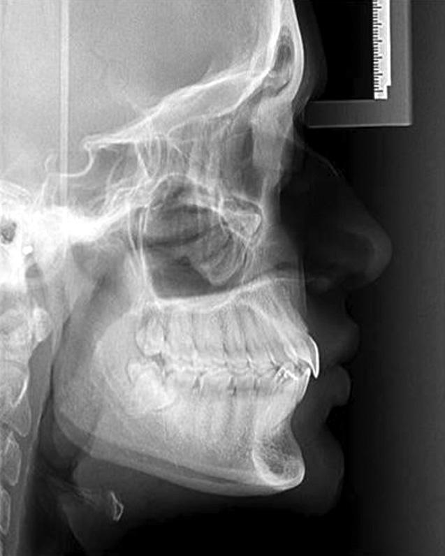 CONCLUSION Orthodontic camouflage using the MPA and MEAW technique is an effective option for correcting Class II malocclusions in patients who refuse orthognathic surgery.