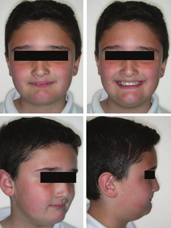 University, Saudi Arabia Abstract The following case report presents an effective orthodontic treatment for an eleven year old male who reported with mild Skeletal Class II jaw base, Class II
