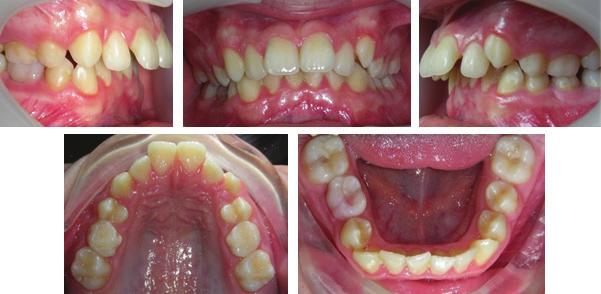 Figure 2: Pre Treatment Intraoral Photographs Soft tissue assessment revealed lip incompetency and lower lip trap with an incisal display of 3 mm at rest, an obtuse nasiolabial angle and deep