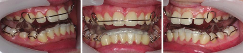 Intra- oral assessment revealed that the patient had mixed dentition with mild gingivitis, mild crowding in upper and lower arches, proclined upper incisors and retroclined lower incisors (Figure 2).