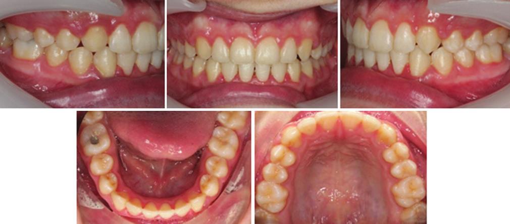 Growth modification with use of functional appliance proclined the lower incisors by 2 to the mandibular plane.