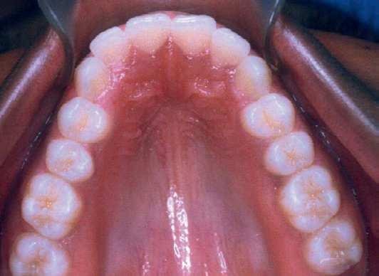 Regarding her dental aspect, she presented Angle s Class II division 1 malocclusion, 5.