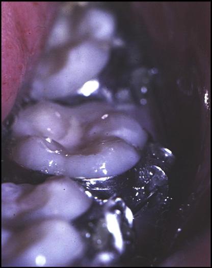 For any torque prescription and archwire combination, the resulting tooth position will be different if the tooth is moved labially than if it is moved lingually.