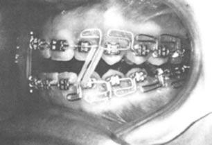 (27) Multi-loop edgewise arch wire technique Skeletal open vertical configuration is characterized by divergent upper and lower occlusal plane and mesially inclined of the dentition.
