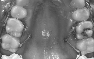The areas in the maxilla that implantation should avoid are the maxillary anterior region because of lip irritation, and the palatal area of the upper central incisors because of incisive foramen