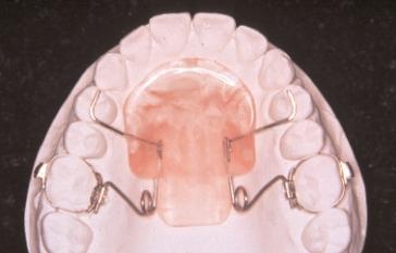 This did not occur with the design I use. Another design change that is becoming popular is the tooth-borne expansion and molar distalizing appliance.