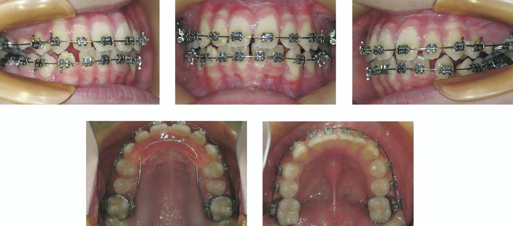 Summary of treatment progress Stage Goal Appliances Duration 1 (Figs 4 and 5) Intrusion and proclination of maxillary incisors Mini-implant Segmented wire