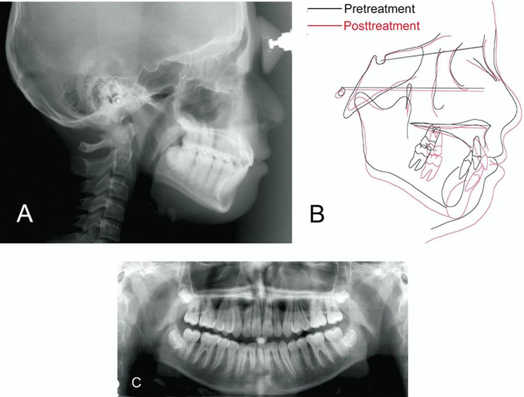 American Journal of Orthodontics and Dentofacial Orthopedics Volume 130, Number 5 Kim, Kim, and Lee 683 Fig 11.
