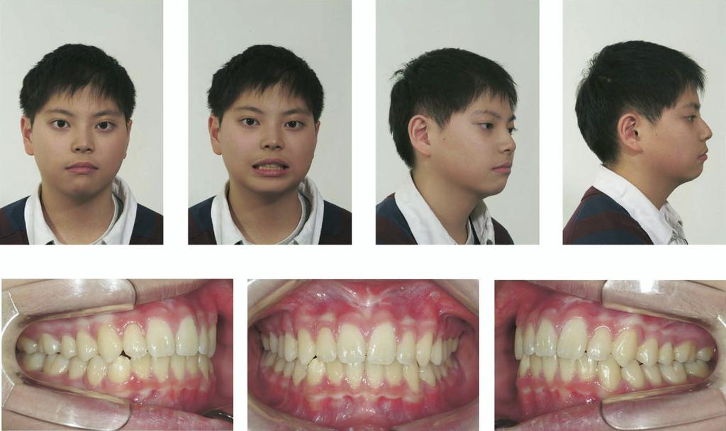 684 Kim, Kim, and Lee American Journal of Orthodontics and Dentofacial Orthopedics November 2006 Fig 12. One-year postretention photographs.