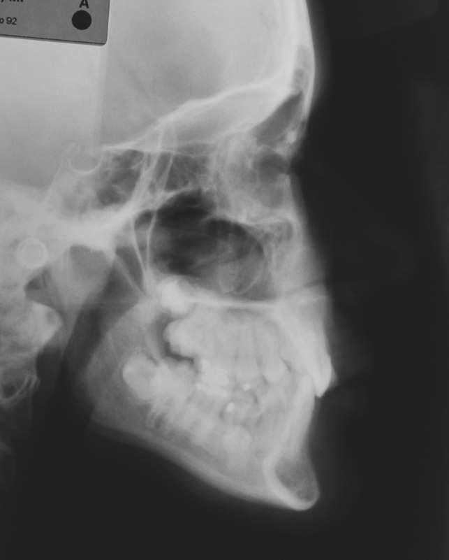 TREATMENT GOALs The treatment goals were correction of Class II skeletal pattern, by reducing the SNA angle, anterior posterior mandibular growth monitoring, obtaining space for the canines and upper