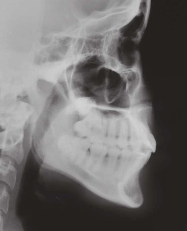 In the final panoramic radiograph some root resorption can be observed, but it is