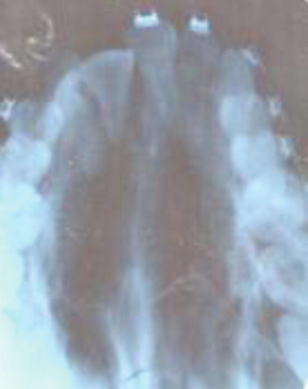 Case Reports in Dentistry 3 Figure 3: X-ray showing favorably impacted canine. retainer in the upper arch and fixed retainer in the lower arch seen in Figure 6. 3. Discussion The noncompliance intraoral molar distalization method has been an excellent compromise for patients who are unwilling to wear headgear.