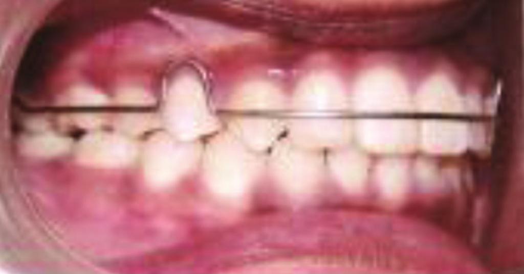 4 Case Reports in Dentistry Figure 6: Postretention with Hawley s retainer and lower fixed retainer at the end of leveling and aligning.