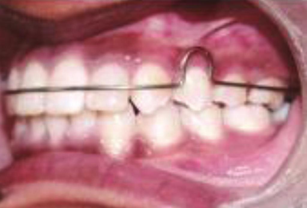 Takemoto, Maxillary molar distalization with a modified pendulum appliance, Clinical Orthodontics, vol. 33, no. 11, pp. 645 650, 1999. [4] A. Keles and K.